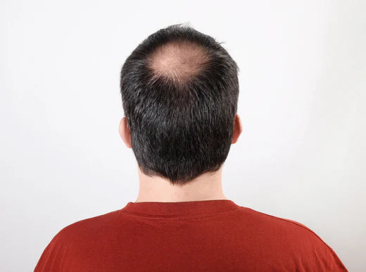 Ways to Combat Thinning Hair for Men